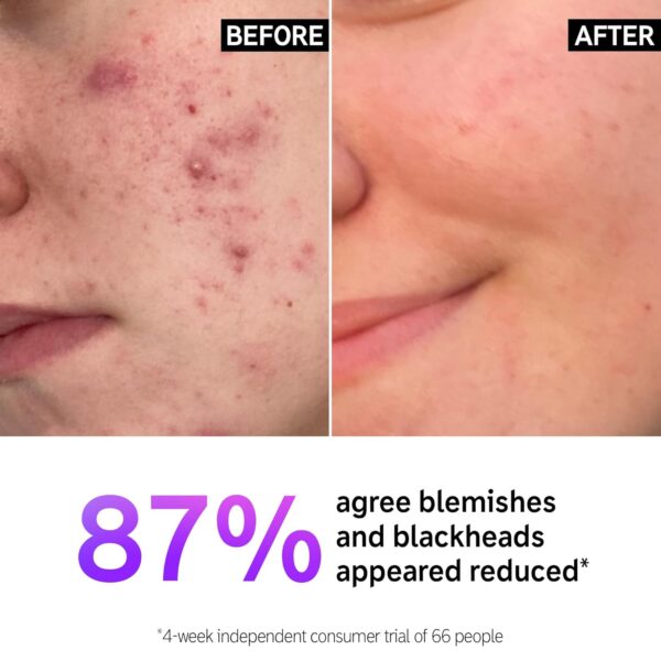 The INKEY List Salicylic Acid Cleanser, Face Wash for Blemishes, Blackheads, Oily Skin and Breakouts, Non-Drying Facial Cleanser Safe for All Skin Types, 5.0 fl oz - Image 2