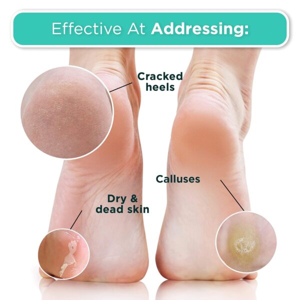 Dermora Foot Peel Mask - 2 Pack of Regular Skin Exfoliating Foot Masks for Dry, Cracked Feet, Callus, Dead Skin Remover - Feet Peeling Mask for Soft Baby Feet, Original Scent - Image 4